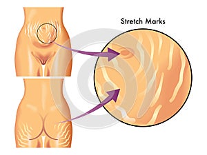 Stretch marks photo