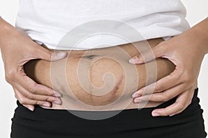 Stretch marks, pregnancy
