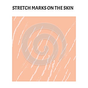 Stretch marks on the skin. Background stretch marks on the skin. Infographics. Vector illustration