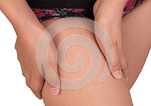 Stretch marks of skin on the thigh