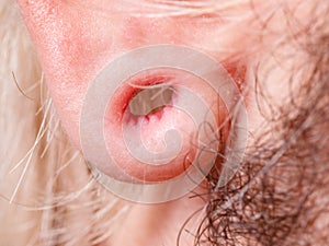 Stretched man ear after tunnel piercing