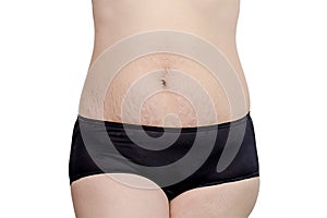 Stretchmarks on woman belly photo