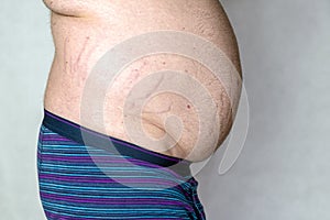 Striae on fat belly