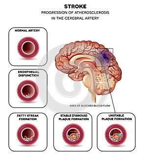Stroke in the brain artery