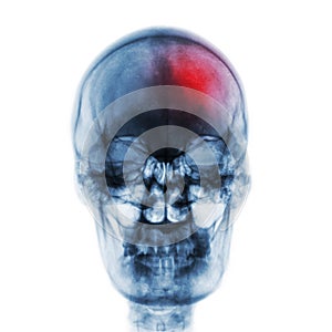 Stroke & x28; Cerebrovascular accident & x29; . Film x-ray skull of human with red area . Front view