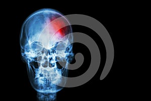 Stroke ( Cerebrovascular accident ) . film x-ray skull of human with red area ( Medical , Science and Healthcare concept and backg