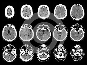 Stroke on CT scans