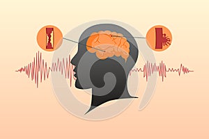 Stroke disease concept. Ischemic and hemorrhagic. Scientific medical illustration of human brain stroke. Vector illustration