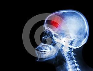 Stroke . film x-ray skull and cervical spine lateral view and stroke . cerebrovascular accident . blank area at left side .