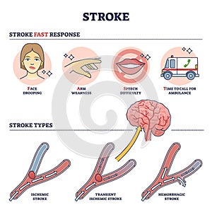 Stroke medical condition with fast response and attack types outline diagram