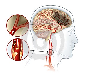 Stroke, medically accurate illustration