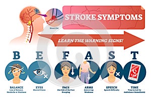 Stroke symptoms vector illustration. Signs of sudden blood clot in head. photo