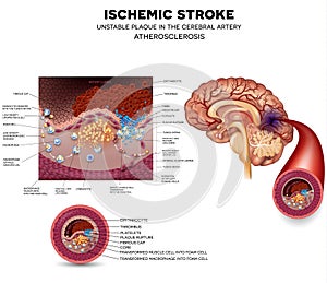 Stroke and thrombus