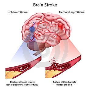 Stroke types poster, banner. Vector medical illustration. white background, anatomy image of damaged human brain