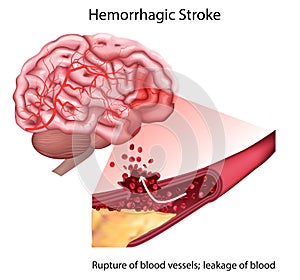 Stroke types poster, banner. Vector medical illustration. white background, anatomy image of damaged human brain