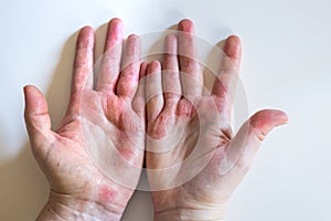 Strong allergic eczema on hands. Red, cracked skin with blisters photo