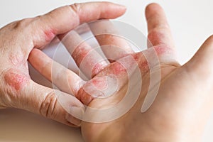 Fuerte alérgico sobre el manos. agrietado piel 