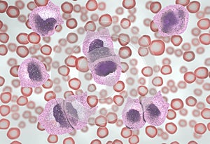 Strong increase of non-functional white blood cells called leukemia cells leading to blood cancer disease