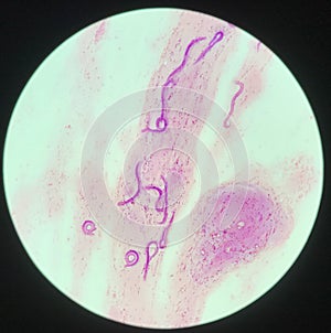 Strongyloides stercoralis parasit in human photo