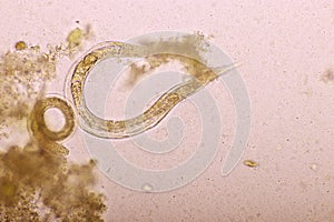 Strongyloides stercoralis or threadworm in human stool