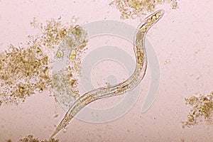 Strongyloides stercoralis or threadworm in human stool