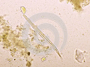 Strongyloides stercoralis or threadworm in human stool