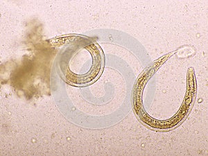 Strongyloides stercoralis or threadworm in human stool