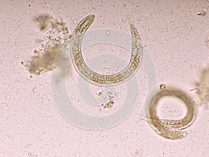 Strongyloides stercoralis or threadworm in human stool