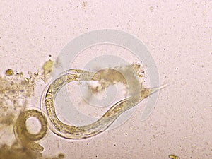 Strongyloides stercoralis or threadworm in human stool