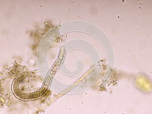 Strongyloides stercoralis or threadworm in human stool