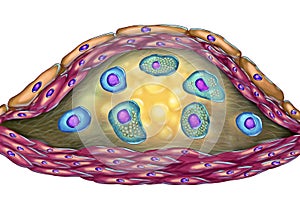 Structure of atherosclerotic plaque