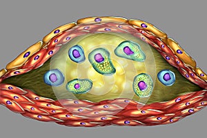 Structure of atherosclerotic plaque