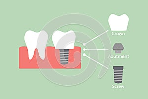 Structure of the dental implant with all parts disassembled, crown, abutment,