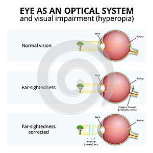 structure of the eyeball, visual impairment, farsightedness