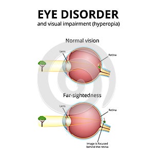 structure of the eyeball, visual impairment, farsightedness