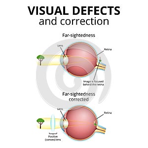 structure of the eyeball, visual impairment, farsightedness
