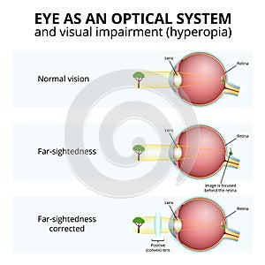 structure of the eyeball, visual impairment, farsightedness photo