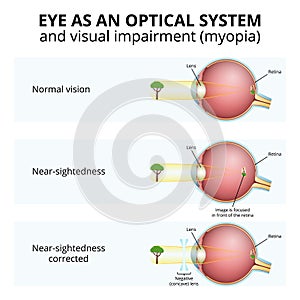 structure of the eyeball, visual impairment, near-sightedness