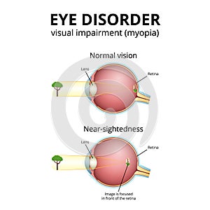 structure of the eyeball, visual impairment, near-sightedness