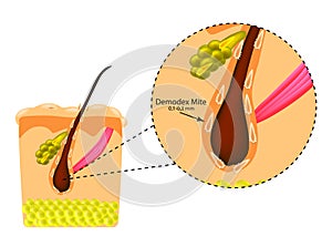 The structure of the hair. Sebaceous gland. Introduction of demodex mite. Demodecosis. Infographics. Vector illustration