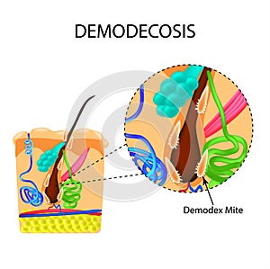 The structure of the hair. Sebaceous gland. Sweat gland. Introduction of demodex mite. Demodecosis. Infographics. Vector