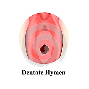 The structure of the vulva hymen Denticular. Hymen after defloration. Female genital organs. Infographics. Vector