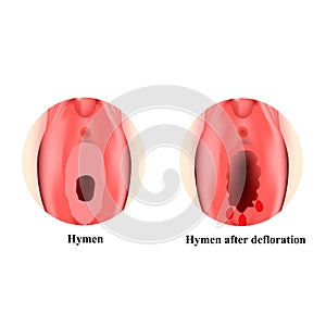 The structure of the vulva hymen. Hymenoplasty. Hymen after defloration. Female genital organs. Infographics. Vector photo