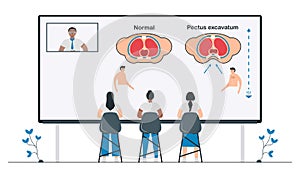 Students study about Pectus excavatum that is a structural deformity of anterior thoracic wall. Pulmonology vector illustration