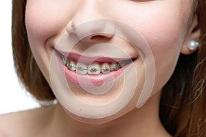Studio close up of model`s beatiful smile with teethbraces.