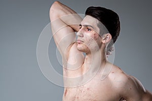 Studio portrait of a young brunette caucasian man on gray background posing. Puberty theme, problem skin, teen acne