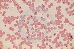 Study of white blood cells are the cells of the immune system under the microscope.