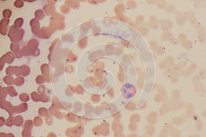 Study of white blood cells are the cells of the immune system under the microscope.