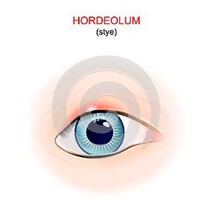 Stye. eye with hordeolum on the upper eyelid photo