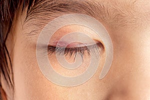 Stye eye infection